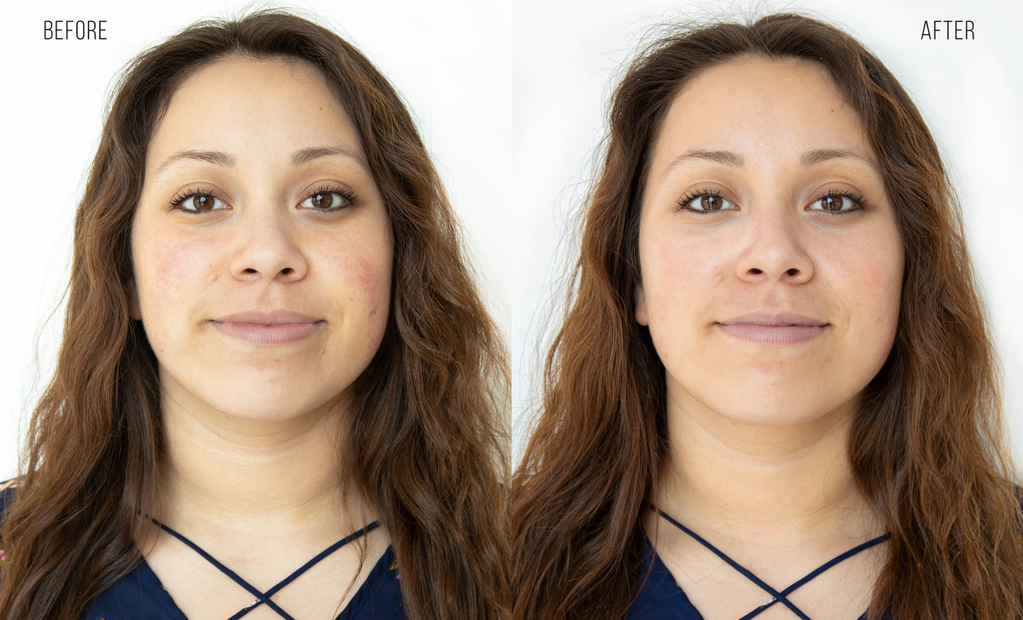 Before and After: Woman completes HydraFacial. The results are reduction in discoloration and redness.