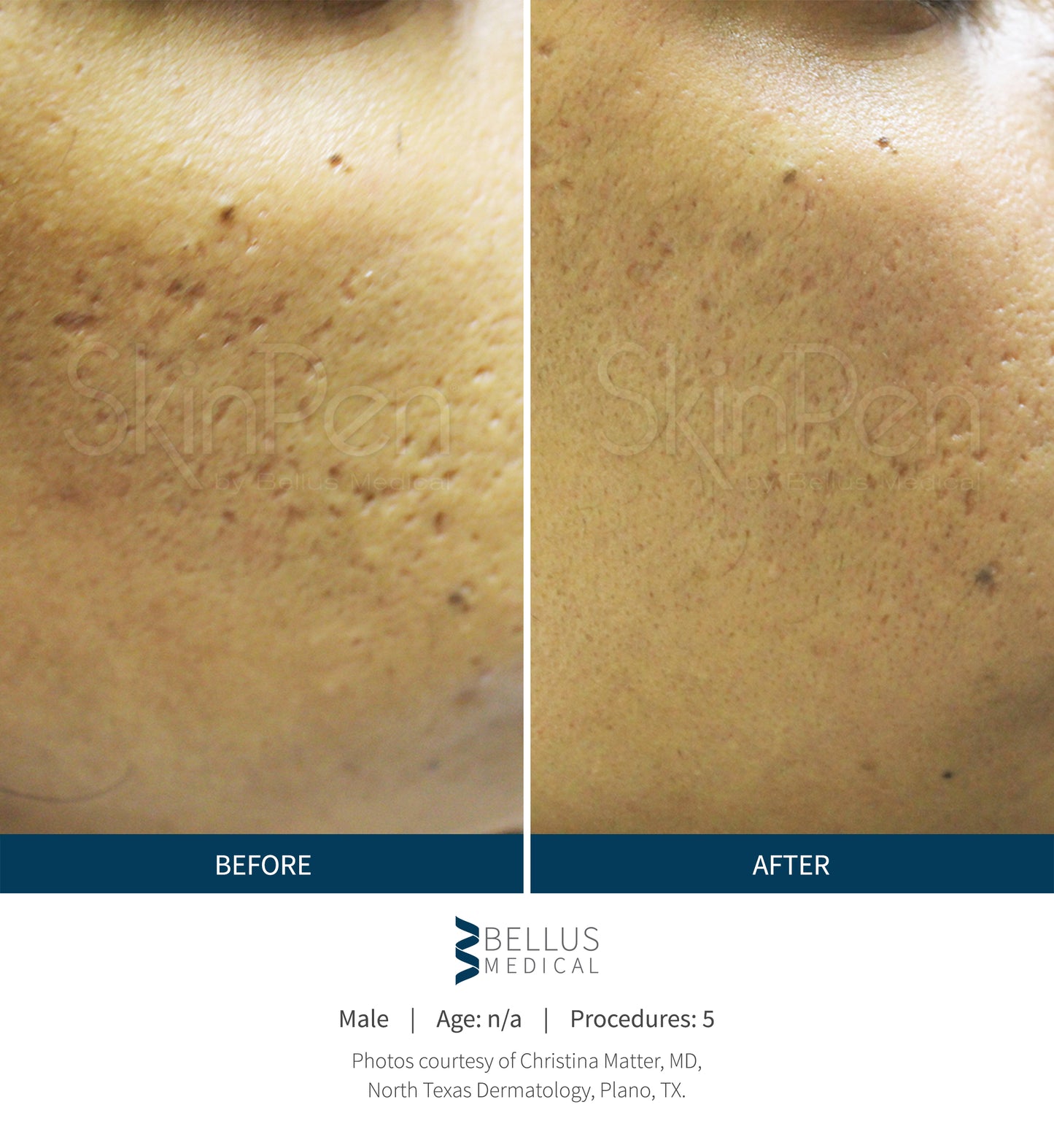 COLLAGEN INDUCTION THERAPY (Microneedling)