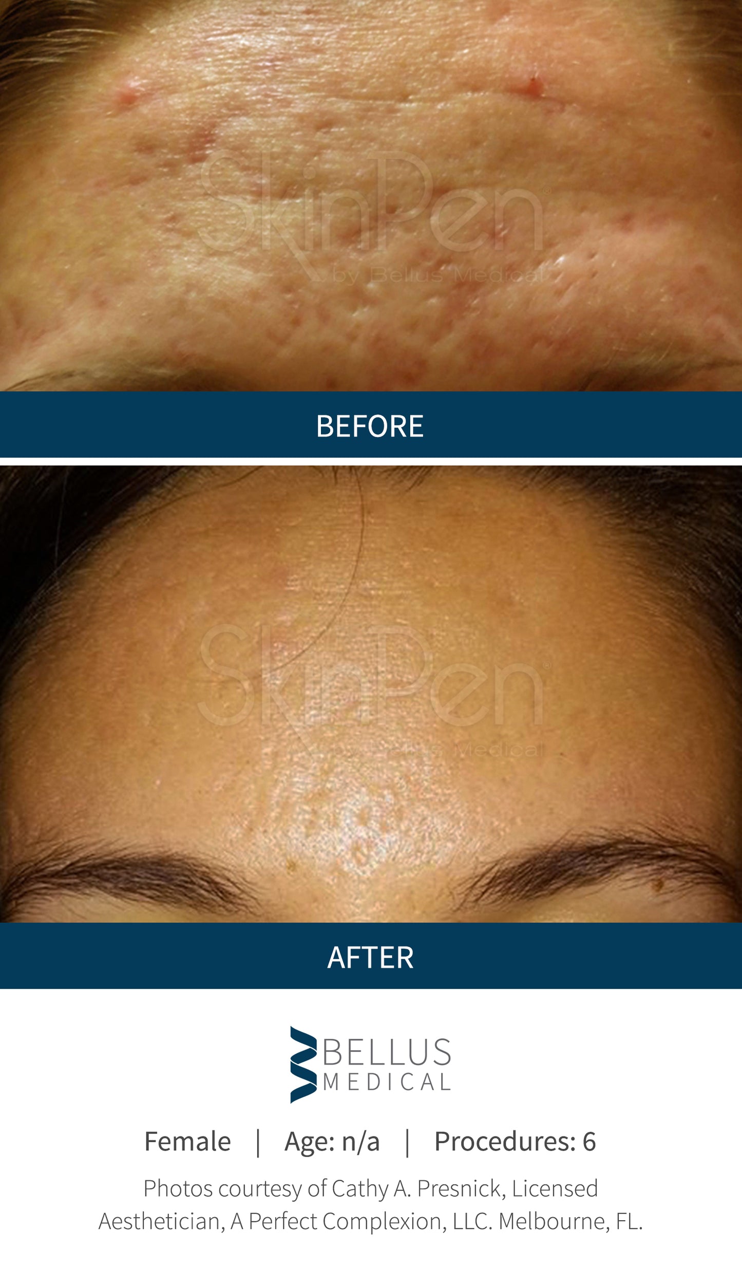 Before:  acne and fine lines on the forehead. After:, the skin is clear and fine lines reduced.