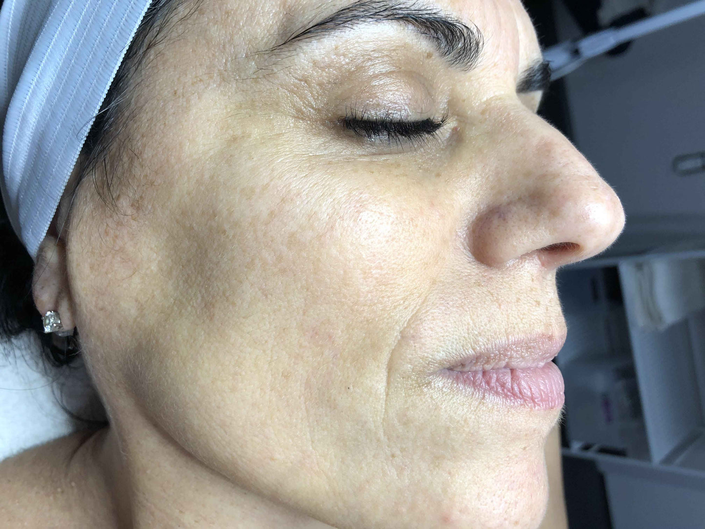 Lumecca IPL Face Treatment