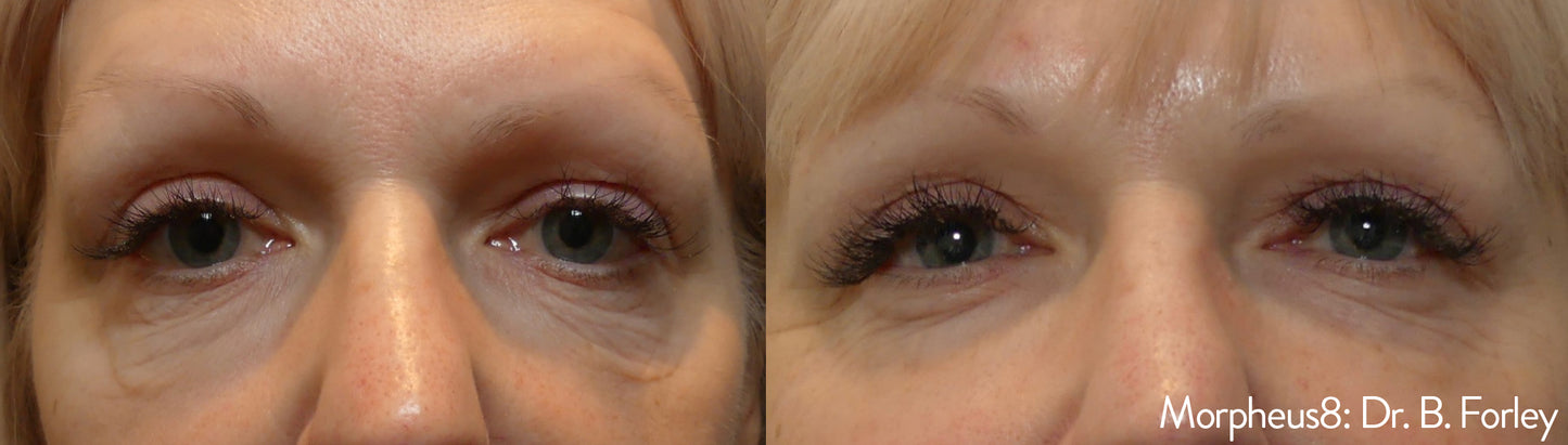 Morpheus8 Face Treatment
