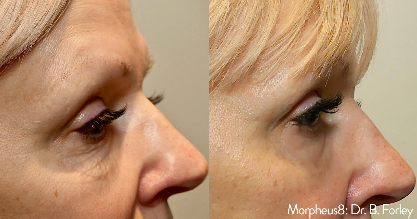 Morpheus8 Face Treatment