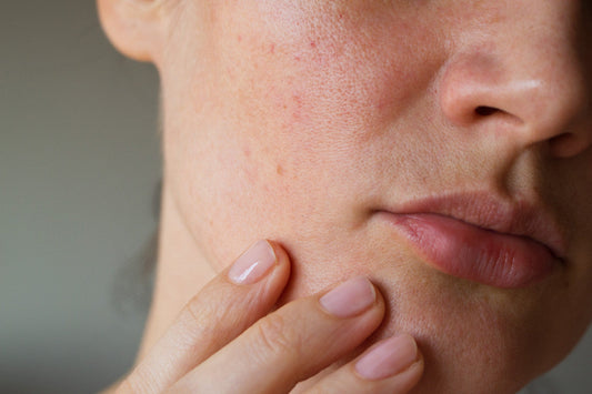 skin barrier