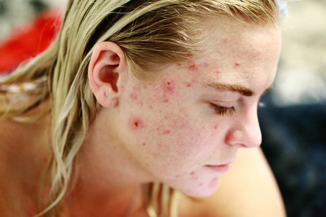 cystic acne