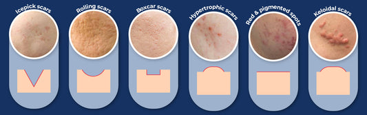 Scar Restoration: Changing Scars into Stars