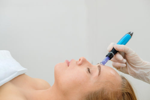 Does Microneedling Help Acne? - Microneedling for Scars