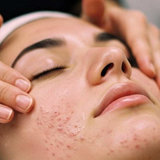 Acne Facial @ Skin Spa New York