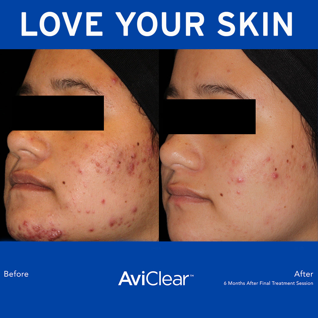 AviClear at Skin Spa New York