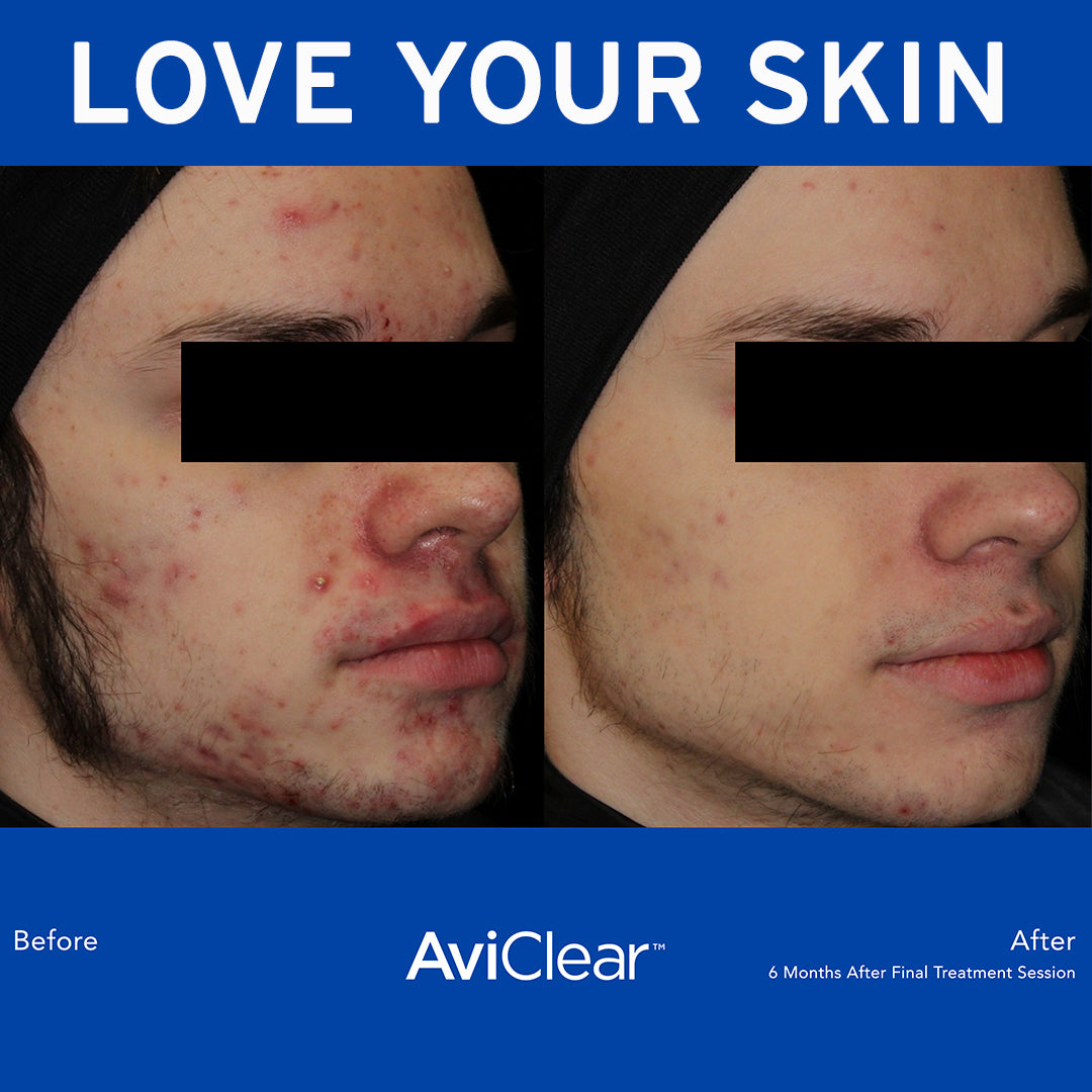 AviClear at Skin Spa New York helps you clear your acne