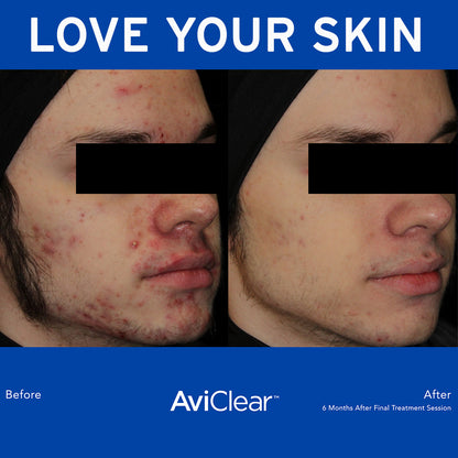 AviClear at Skin Spa New York helps you clear your acne