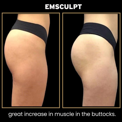 Before and After: Woman completes Emsculpt body sculpting treatment. The results are a great increase in muscle in the buttocks.