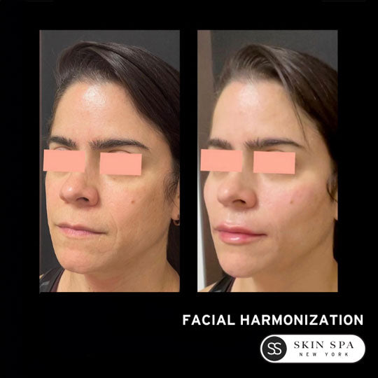 Cosmetic Injectables @ Skin Spa New York
