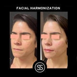 Facial Harmonization @ Skin Spa New York