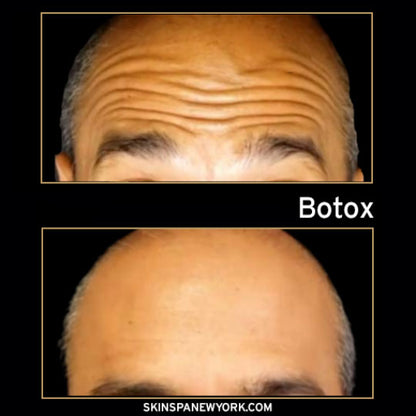 Neuromodulators (Botox, Dysport, Xeomin)