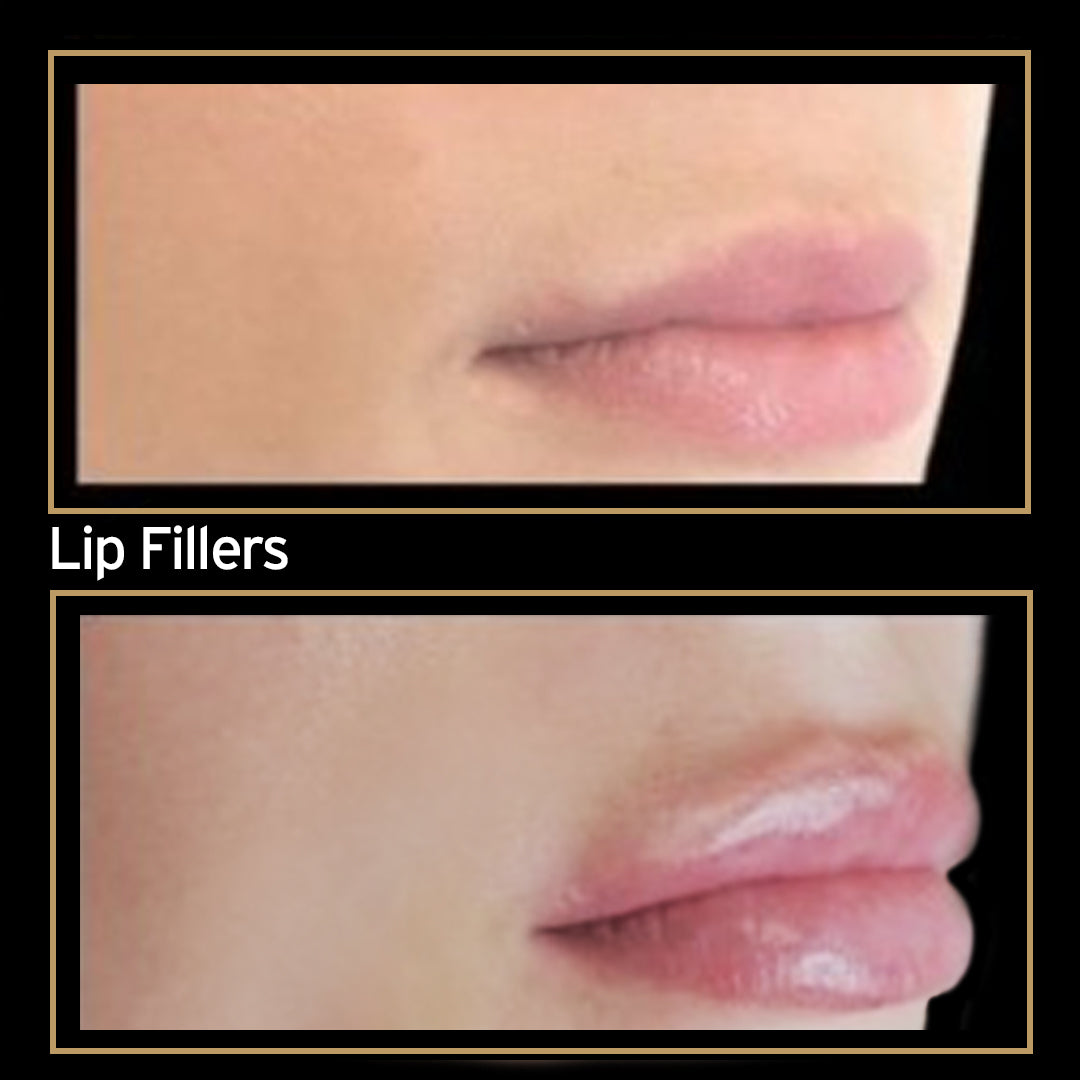 Lips augmented with Fillers @ Skin Spa New York