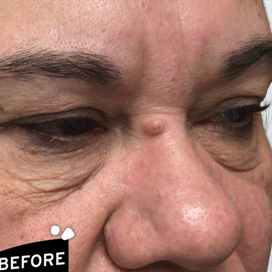 Morpheus8 @ Skin Spa New York