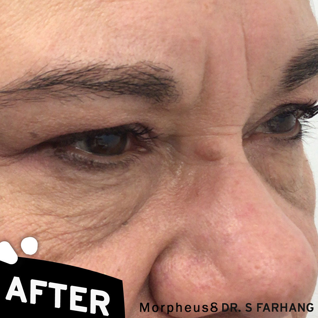 Morpheus8 Face Treatment