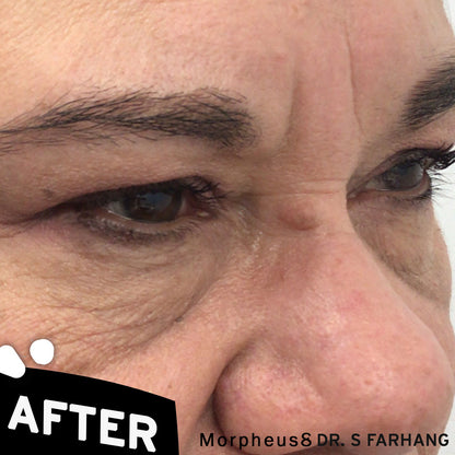 Morpheus8 Face Treatment