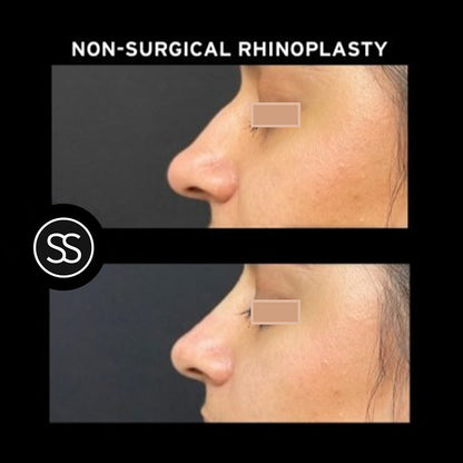 Non-Surgical Rhinoplasty