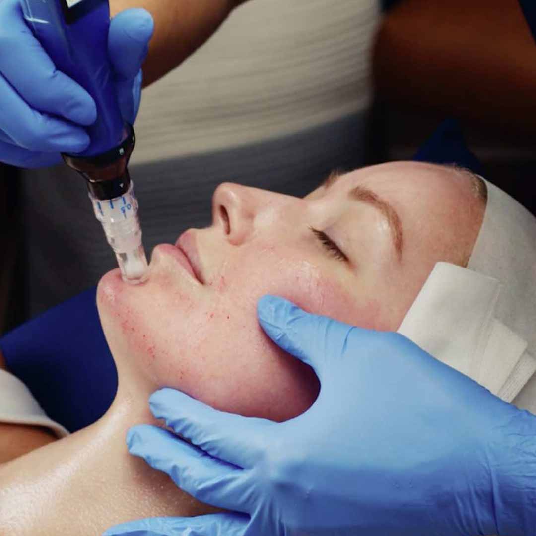SKINPEN COLLAGEN INDUCTION THERAPY (CIT)