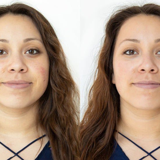 Before and After: Woman completes HydraFacial. The results are reduction in discoloration and redness. 