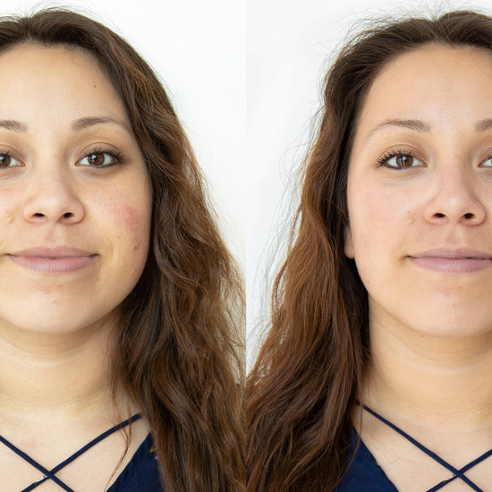 Before and After: Woman completes HydraFacial. The results are reduction in discoloration and redness. 