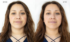 Before and After: Woman completes HydraFacial. The results are reduction in discoloration and redness. 