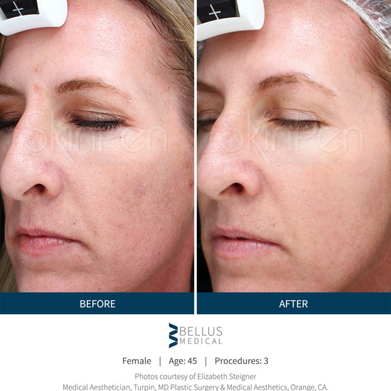 Before and After Mircroneedling. Before there was discoloration throughout the face. After microneedling treatments, the skin is tone is even and redness is reduced.