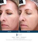 Before and After Mircroneedling. Before there was discoloration throughout the face. After microneedling treatments, the skin is tone is even and redness is reduced.