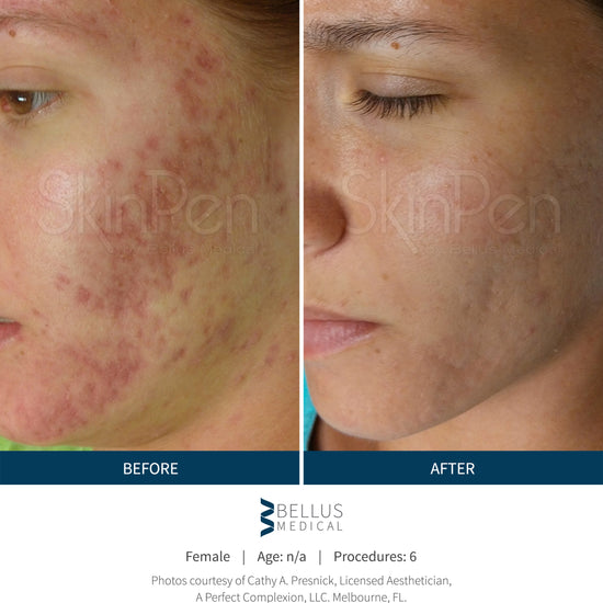 Collagen Induction Therapy @ Skin Spa New York