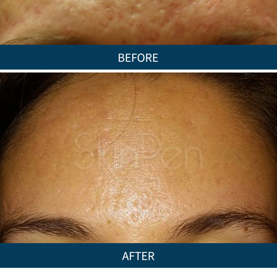 Before:  acne and fine lines on the forehead. After:, the skin is clear and fine lines reduced.