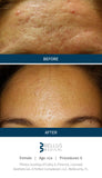 Before and After Mircroneedling. Before there was acne and fine lines on the forehead. After microneedling treatments, the skin is clear and fine lines reduced.