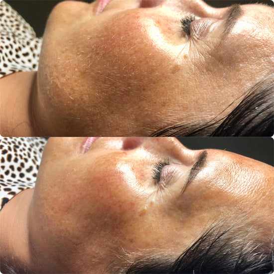 Dermaplaning @ Skin Spa New York