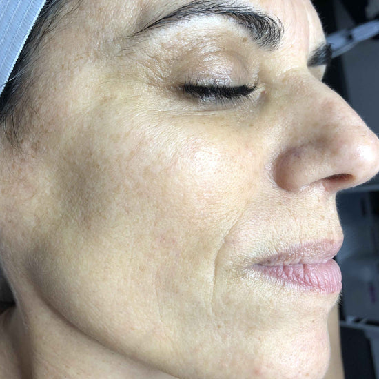 Lumecca IPL Face Treatment