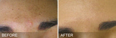 Before and After: Woman completes HydraFacial. The results are uneven skin tone and texture is improved.