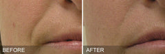 Before and After: Woman completes HydraFacial. Results are reduction in redness and more even skin tone.