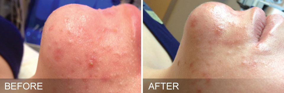 Before and After: Woman completes HydraFacial. The results are skin redness is drastically reduced after just one HydraFacial treatment and acne has cleared up.