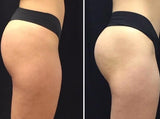 Before and After: Woman completes Emsculpt body sculpting treatment. The results are a great increase in muscle in the buttocks.