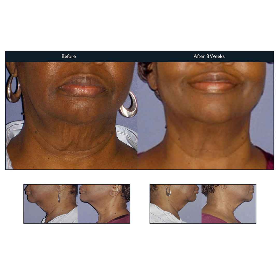 Forma Skin Tightening | Noninvasive | Skin Spa New York
