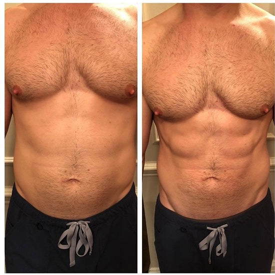 Before and After: Man undergoes Emsculpt body sculpting treatment. The results are more defined abs and weight loss around the stomach.