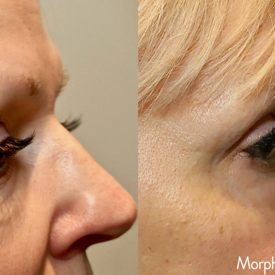 Morpheus8 @ Skin Spa New York