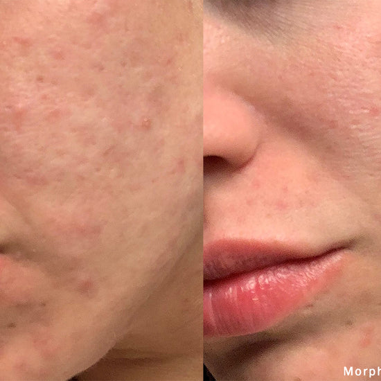 Morpheus8 @ Skin Spa New York
