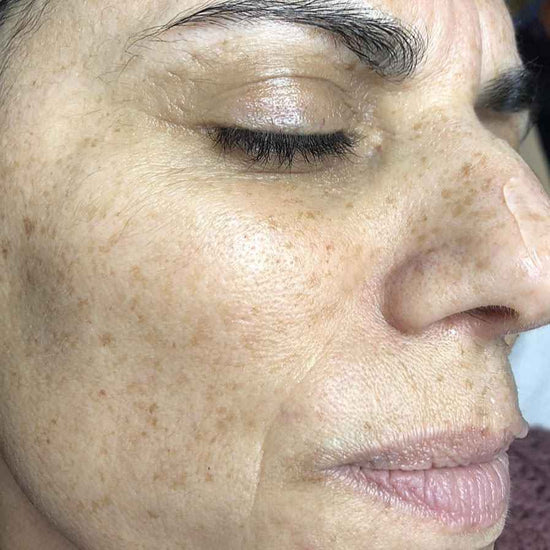 Lumecca IPL Face Treatment