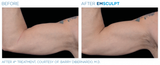 Before and After: Woman completes Emsculpt body sculpting treatment. The results are muscle gain and definition in the biceps.