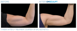 Before and After: Woman completes Emsculpt body sculpting treatment. The results are muscle gain and definition in the biceps.